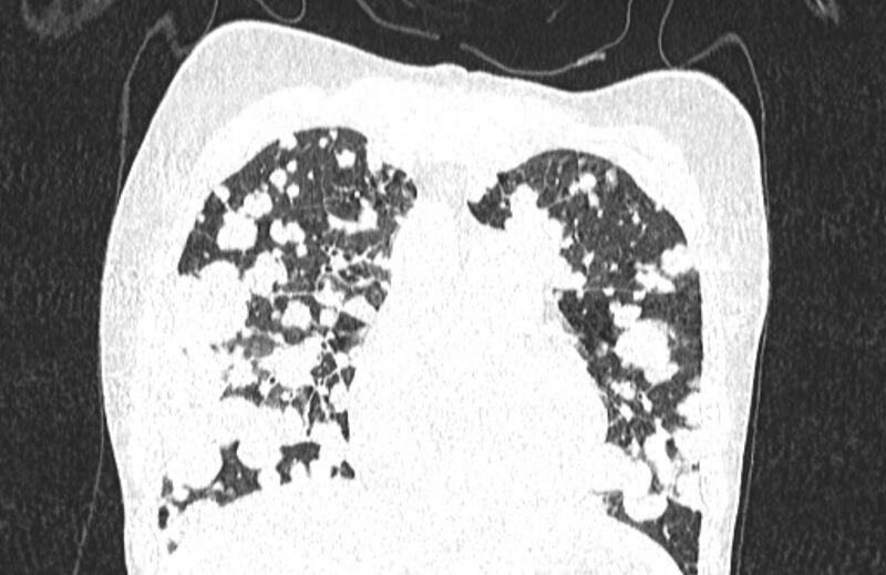 File:Cannonball metastases from breast cancer (Radiopaedia 91024-108569 Coronal lung window 46).jpg
