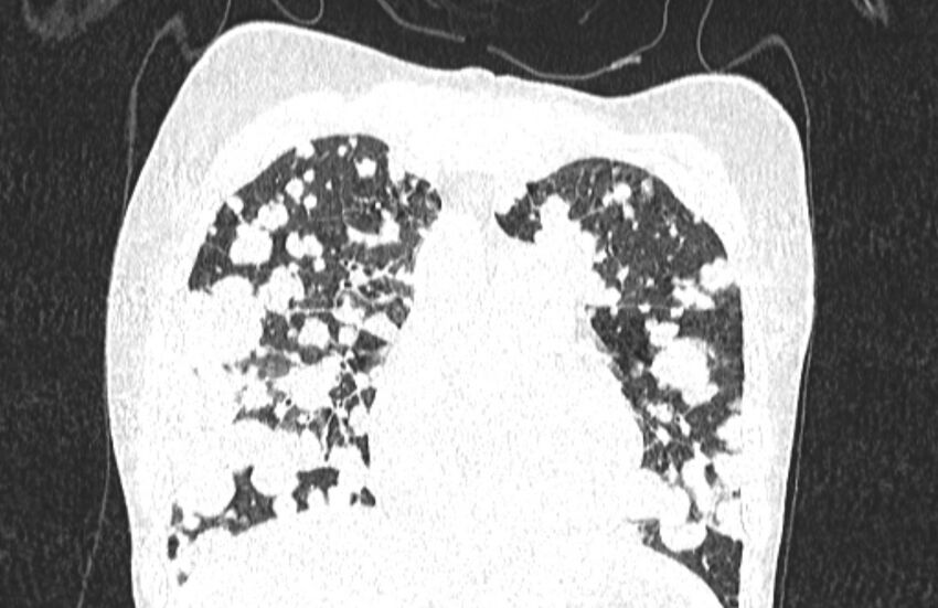 Cannonball metastases from breast cancer (Radiopaedia 91024-108569 Coronal lung window 46).jpg