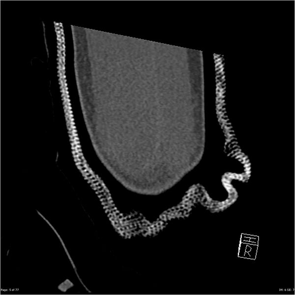 File:Capitellum fracture (Radiopaedia 23352-23426 Coronal bone window 5).jpg