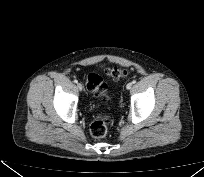 File:Carcinoid tumor with hepatic metastases (Radiopaedia 22651-22670 C 72).jpg