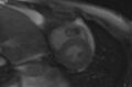 Cardiac hemangioma (Radiopaedia 31709-32631 E 39).jpg