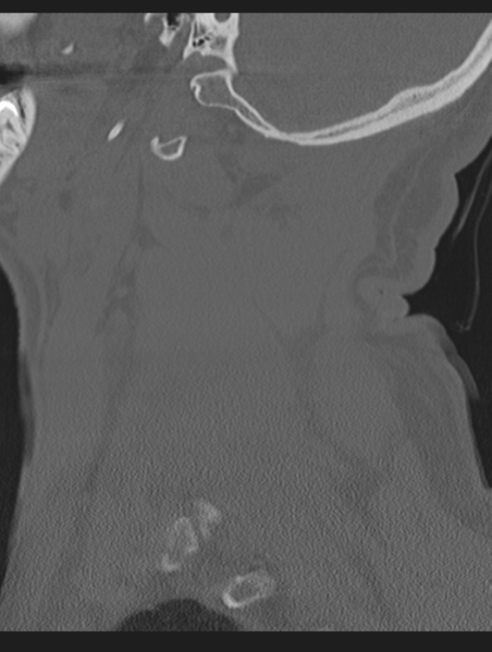 File:Cavernoma of cervical cord (Radiopaedia 50838-56346 Sagittal bone window 16).png