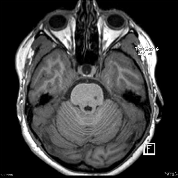 File:Cavernous malformation (cavernous angioma or cavernoma) (Radiopaedia 36675-38237 Axial T1 36).jpg