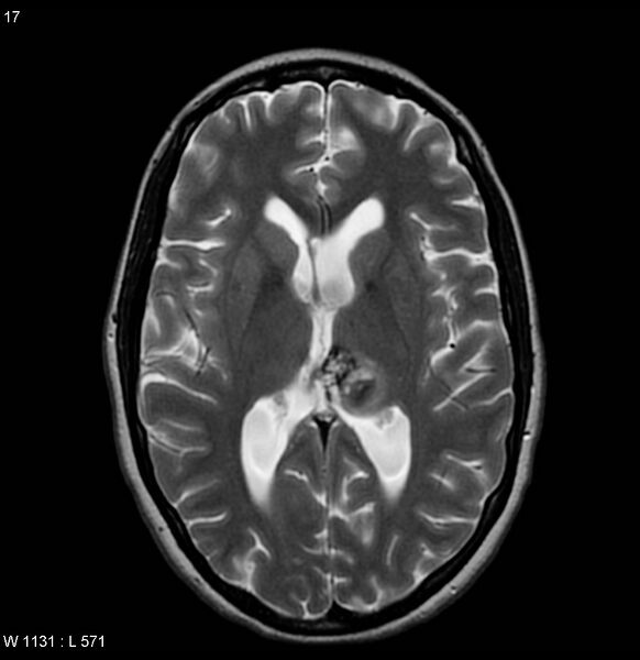File:Cavernous malformation of the midbrain (Radiopaedia 7791-8615 Axial T2 6).jpg