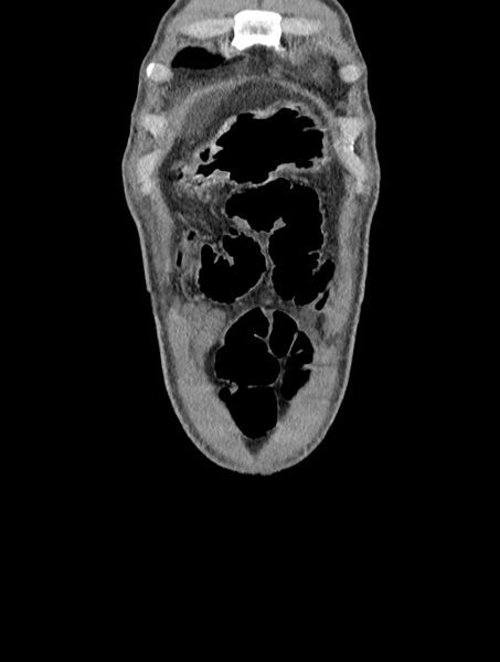 File:Cavernous transformation of portal vein (Radiopaedia 88540-105207 B 5).jpg