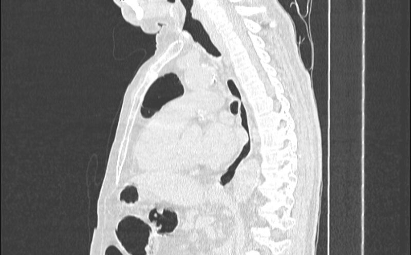File:Cavitating bronchogenic carcinoma (Radiopaedia 44489-48162 Sagittal lung window 34).jpg