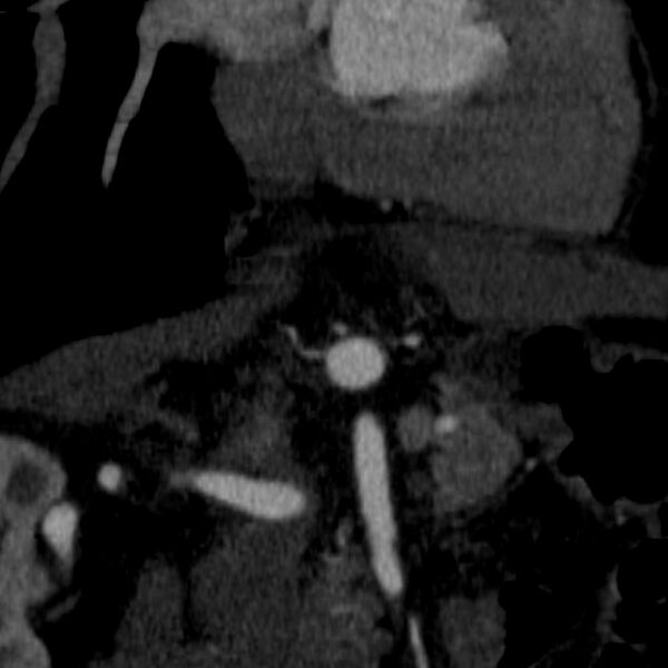 File:Celiac artery aneurysm (Radiopaedia 21574-21525 B 12).JPEG