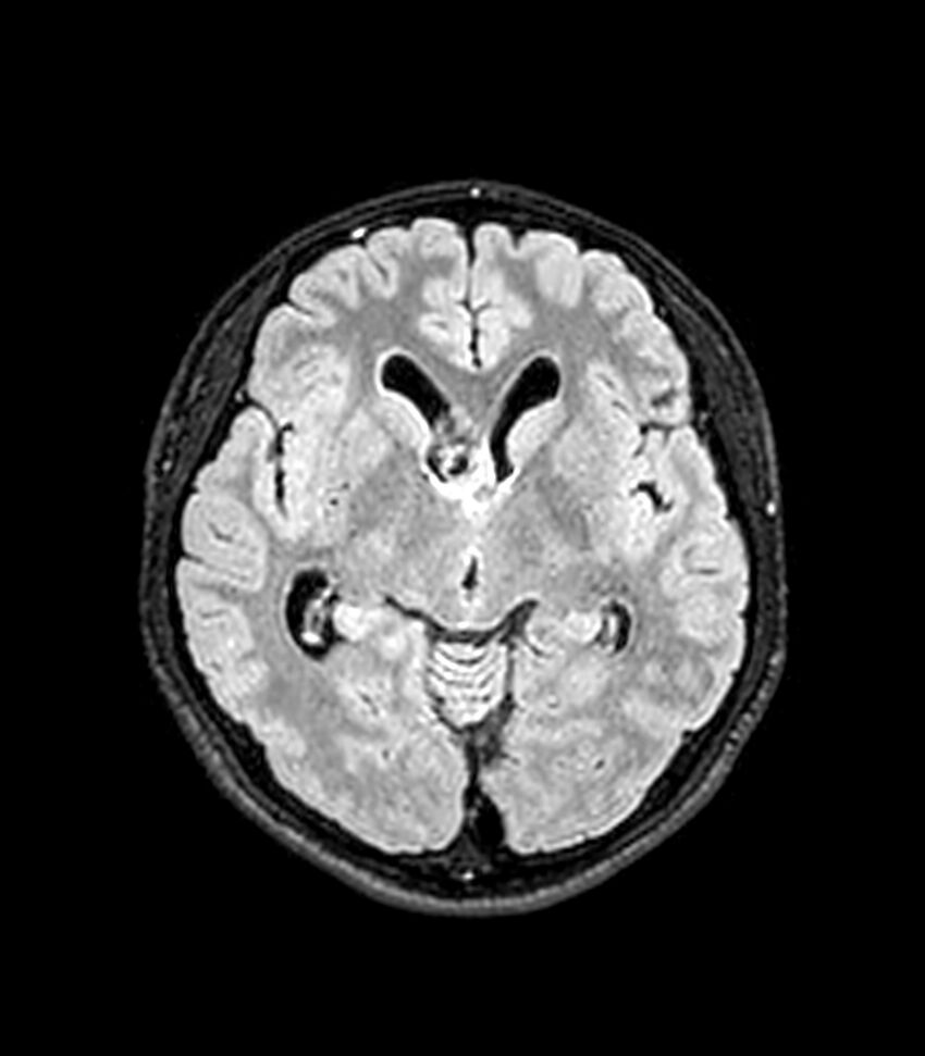 Central neurocytoma (Radiopaedia 79320-92380 Axial FLAIR 174).jpg