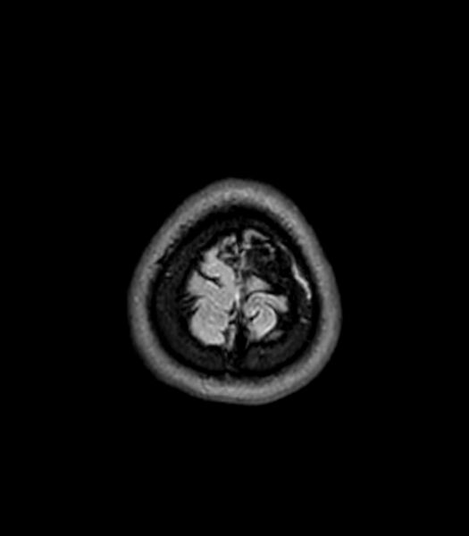 File:Central neurocytoma (Radiopaedia 79320-92380 Axial FLAIR 38).jpg