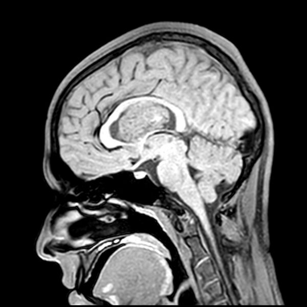 File:Central neurocytoma (Radiopaedia 79320-92380 Sagittal T1 126).jpg