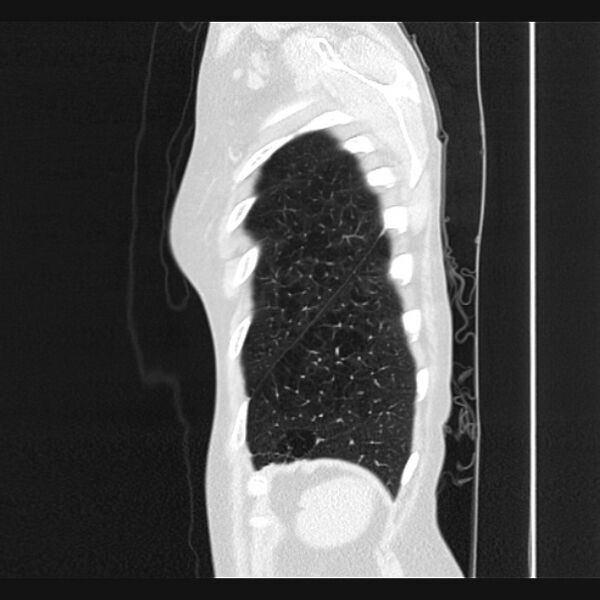 File:Centrilobular pulmonary emphysema (Radiopaedia 24495-24789 Sagittal lung window 78).jpg