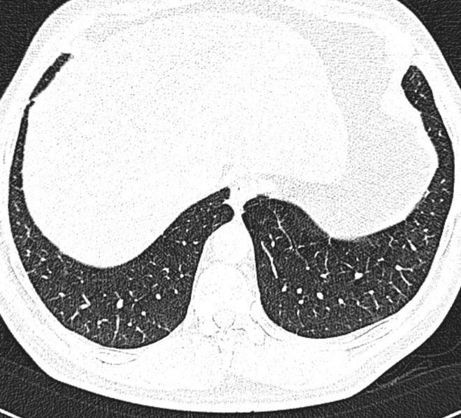File:Centrilobular pulmonary emphysema (Radiopaedia 26808-26971 Axial lung window 33).jpg