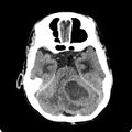 Cerebellar abscess secondary to mastoiditis (Radiopaedia 26284-26412 Axial non-contrast 48).jpg