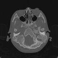 Cerebellar abscess secondary to mastoiditis (Radiopaedia 26284-26413 Axial bone window 29).jpg