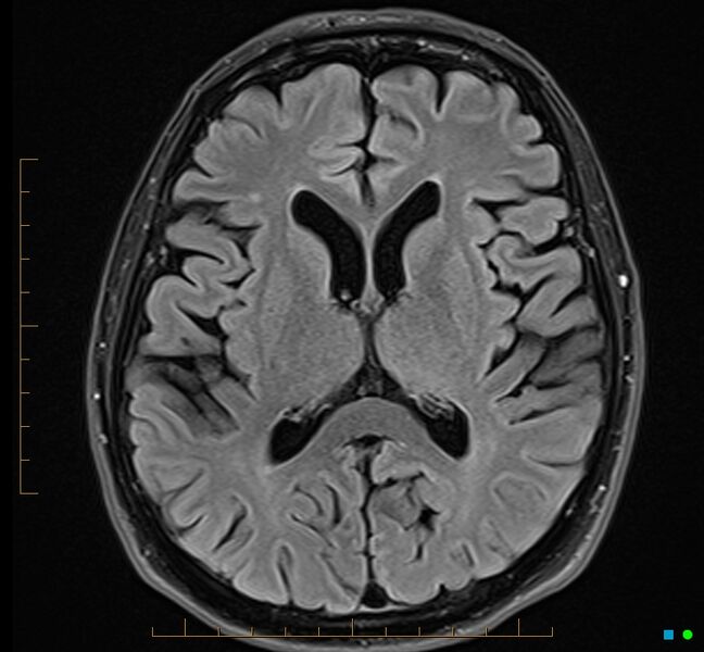 File:Cerebellar gangliocytoma (Radiopaedia 65377-74422 Axial FLAIR 21).jpg