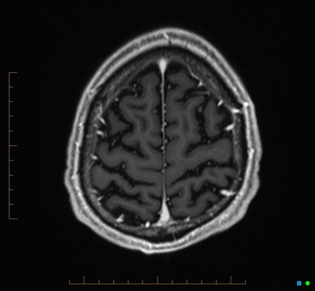 File:Cerebellar gangliocytoma (Radiopaedia 65377-74422 Axial T1 C+ 124).jpg