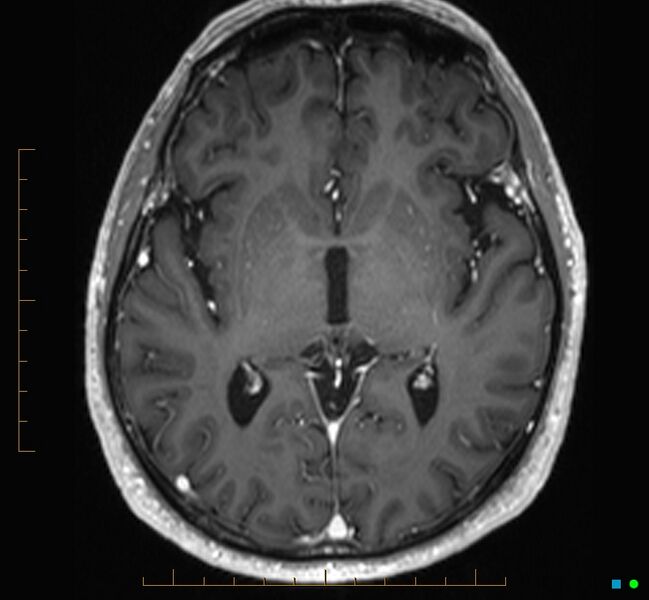 File:Cerebellar gangliocytoma (Radiopaedia 65377-74422 Axial T1 C+ 63).jpg