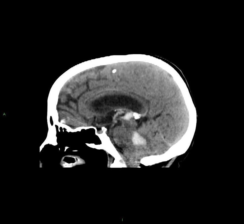 Cerebellar hemorrhage (Radiopaedia 58793-66027 C 26).jpg