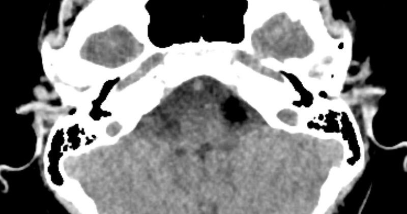 File:Cerebellopontine angle lipoma (Radiopaedia 57303-64242 B 24).jpg