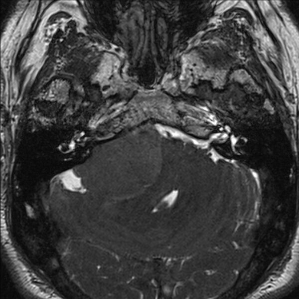 File:Cerebellopontine angle meningioma (Radiopaedia 24459-24764 I 21).jpg