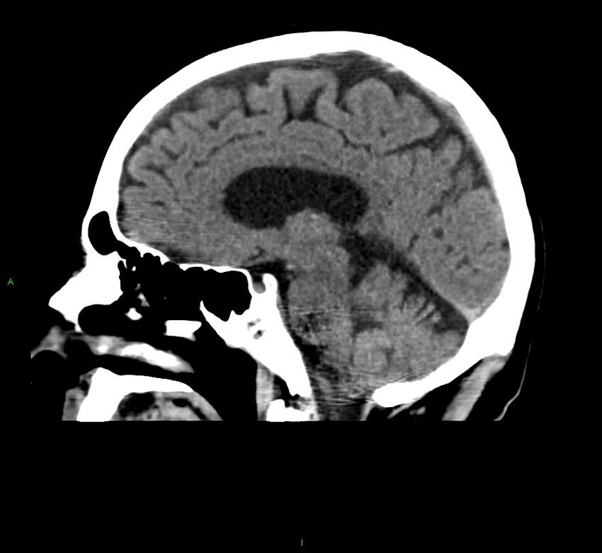 Cerebral amyloid angiopathy-associated lobar intracerebral hemorrhage (Radiopaedia 58376-65511 C 25).jpg