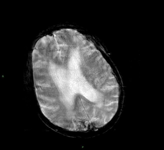 File:Cerebral amyloid angiopathy-associated lobar intracerebral hemorrhage (Radiopaedia 58377-65515 Axial Gradient Echo 11).jpg