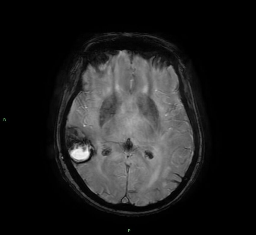 Cerebral amyloid angiopathy-associated lobar intracerebral hemorrhage (Radiopaedia 58378-65517 Axial SWI 37).jpg