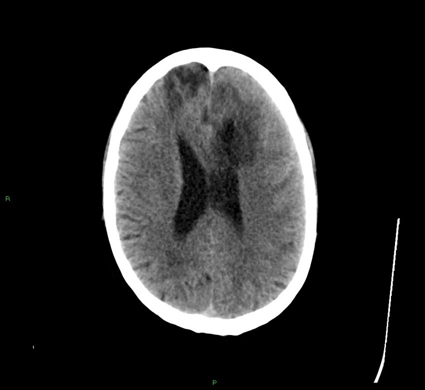 Cerebral amyloid angiopathy-associated lobar intracerebral hemorrhage (Radiopaedia 58529-65681 Axial non-contrast 20).jpg