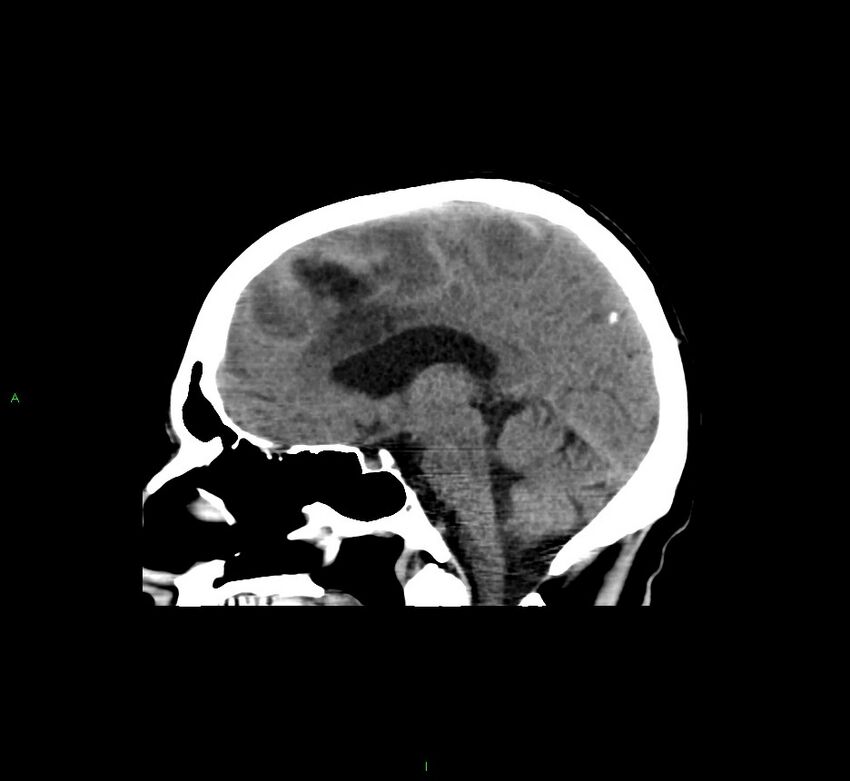 Cerebral amyloid angiopathy-associated lobar intracerebral hemorrhage (Radiopaedia 58529-65681 B 26).jpg