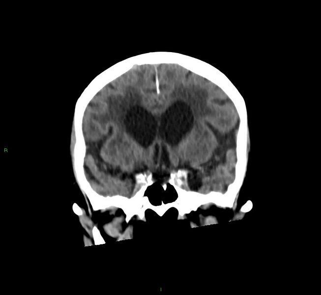 File:Cerebral amyloid angiopathy-associated lobar intracerebral hemorrhage (Radiopaedia 58530-65688 Coronal non-contrast 44).jpg