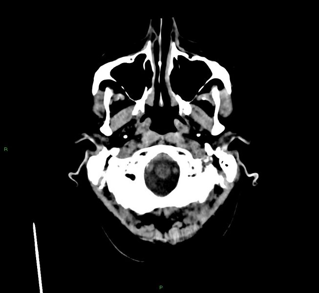 File:Cerebral amyloid angiopathy-associated lobar intracerebral hemorrhage (Radiopaedia 58560-65723 Axial non-contrast 48).jpg