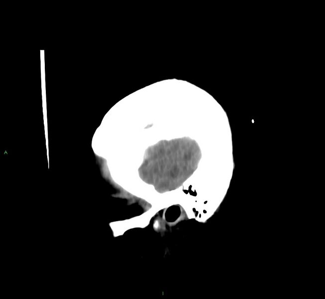 File:Cerebral amyloid angiopathy-associated lobar intracerebral hemorrhage (Radiopaedia 58566-65730 C 5).jpg