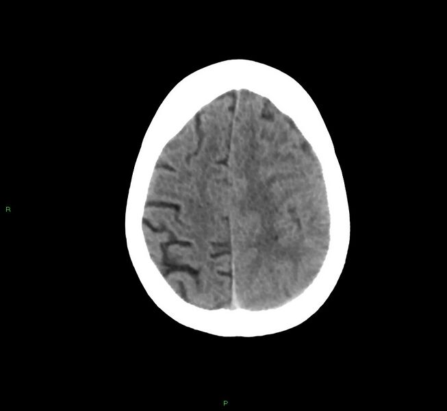 File:Cerebral amyloid angiopathy-associated lobar intracerebral hemorrhage (Radiopaedia 58754-65975 Axial non-contrast 20).jpg