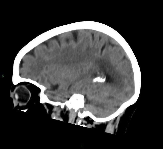 File:Cerebral amyloid angiopathy-associated lobar intracerebral hemorrhage (Radiopaedia 58757-65978 C 37).jpg