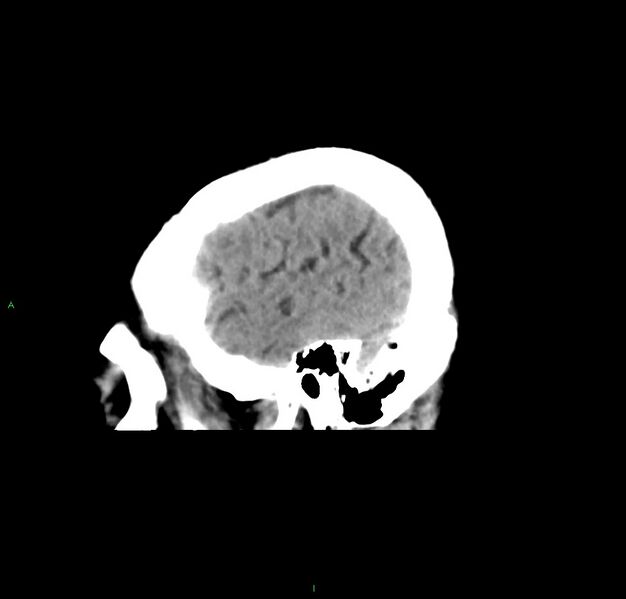 File:Cerebral amyloid angiopathy-associated lobar intracerebral hemorrhage (Radiopaedia 59356-66716 C 11).jpg