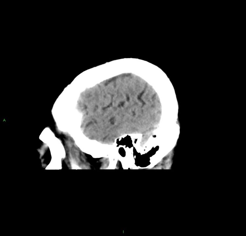 Cerebral amyloid angiopathy-associated lobar intracerebral hemorrhage (Radiopaedia 59356-66716 C 11).jpg