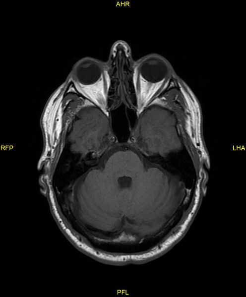 File:Cerebral autosomal dominant arteriopathy with subcortical infarcts and leukoencephalopathy (CADASIL) (Radiopaedia 86108-102054 Axial T1 9).jpg