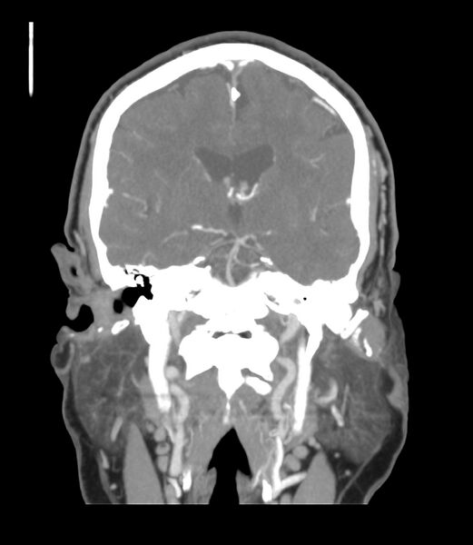 File:Cerebral dural venous sinus thrombosis (Radiopaedia 86514-102576 B 33).jpg