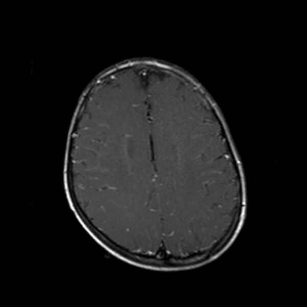 File:Cerebral tuberculoma (Radiopaedia 41152-43932 Axial T1 C+ 16).jpg