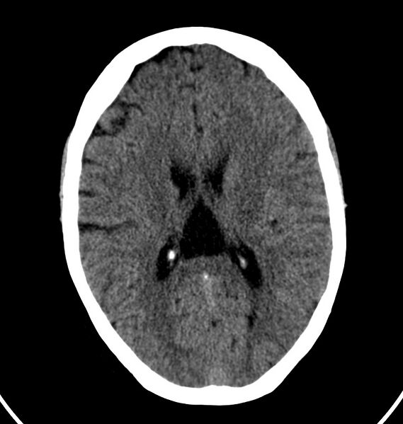 File:Cerebral venous thrombosis - CT only (Radiopaedia 41031-43778 Axial non-contrast 35).jpg