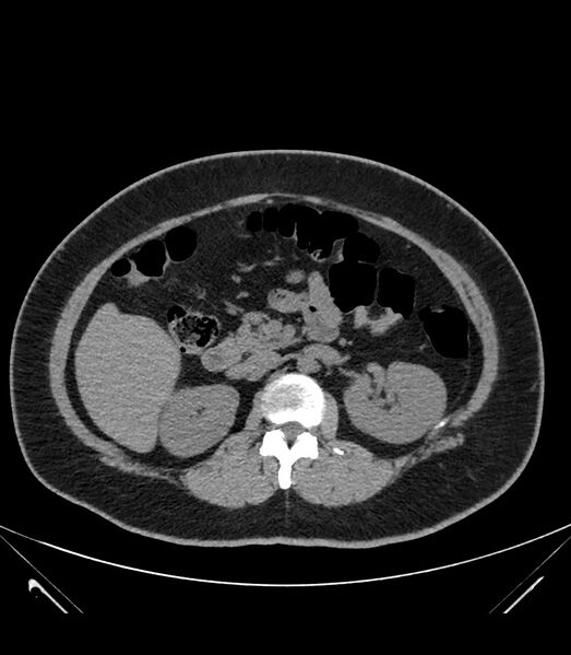 File:Cervical aortic arch with coarctation and aneurysms (Radiopaedia 44035-47552 Axial non-contrast 55).jpg