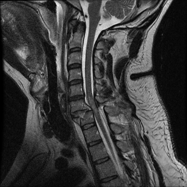 File:Cervical fracture and dislocation with locked facet (Radiopaedia 31837-32781 Sagittal T2 7).jpg