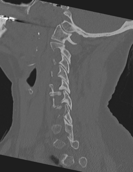 File:Cervical spine ACDF loosening (Radiopaedia 48998-54071 Sagittal bone window 31).png