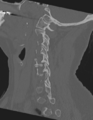 Cervical spine ACDF loosening (Radiopaedia 48998-54071 Sagittal bone window 31).png