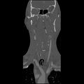 Cervical spine fractures with vertebral artery dissection (Radiopaedia 32135-33078 Coronal bone window 1).jpg
