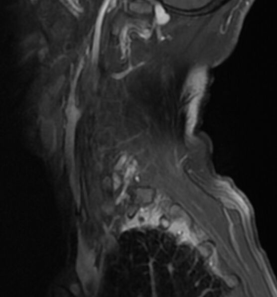File:Cervical spondylodiscitis (Radiopaedia 81362-95110 E 1).jpg