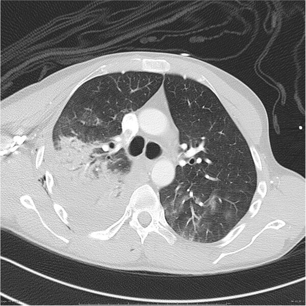File:Chest and abdomen multi-trauma (Radiopaedia 26294-26425 lung window 42).jpg