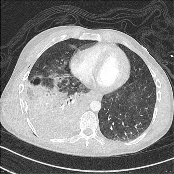 File:Chest and abdomen multi-trauma (Radiopaedia 26294-26425 lung window 73).jpg
