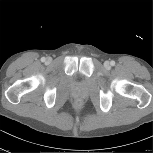 File:Chest and abdomen multi-trauma (Radiopaedia 26294-26426 bone window 89).jpg