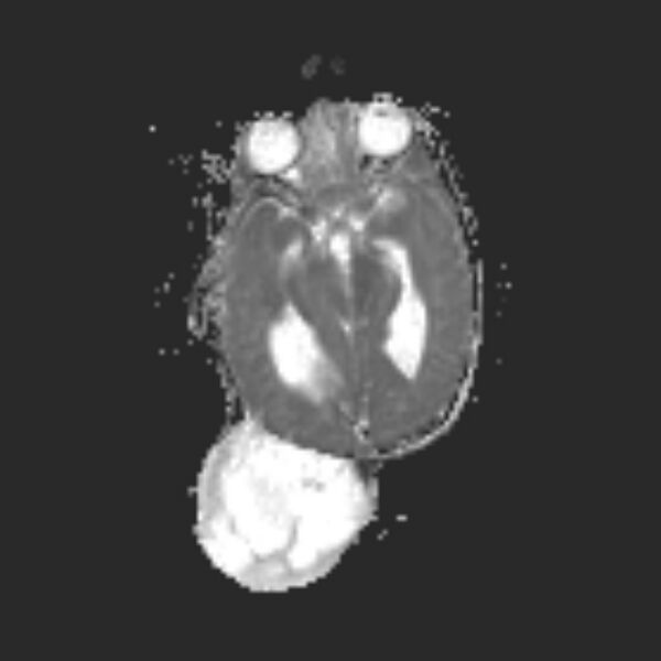 File:Chiari III malformation with occipital encephalocele (Radiopaedia 79446-92559 Axial ADC 12).jpg